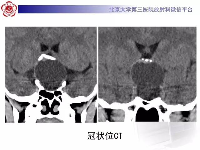 【病例】颅咽管瘤1例CT及MR影像表现
