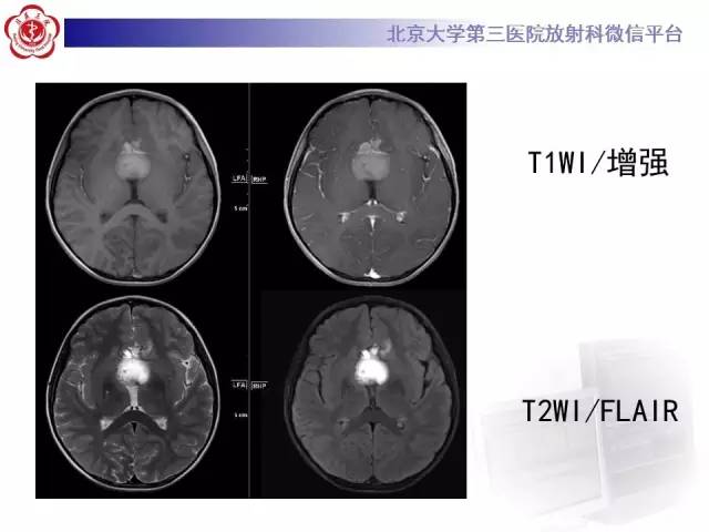 【病例】颅咽管瘤1例CT及MR影像表现