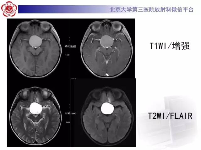 【病例】颅咽管瘤1例CT及MR影像表现