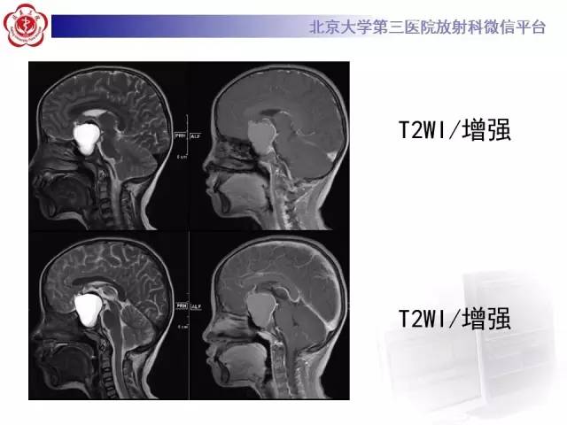 【病例】颅咽管瘤1例CT及MR影像表现