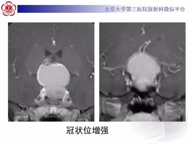 【病例】颅咽管瘤1例CT及MR影像表现