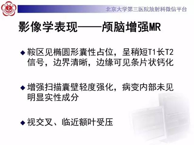 【病例】颅咽管瘤1例CT及MR影像表现