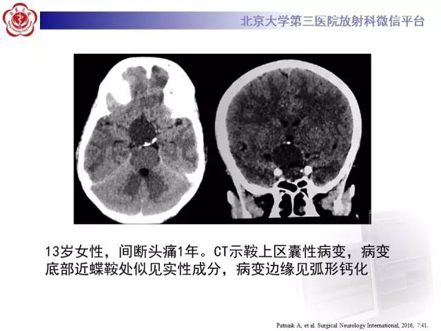 【病例】颅咽管瘤1例CT及MR影像表现