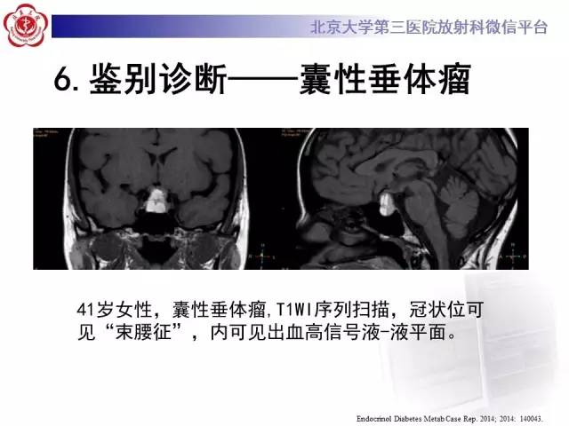【病例】颅咽管瘤1例CT及MR影像表现