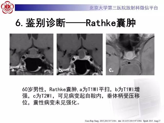 【病例】颅咽管瘤1例CT及MR影像表现