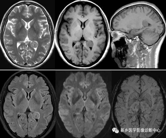 在侧脑室三角区看到占位，要想到这8种肿瘤