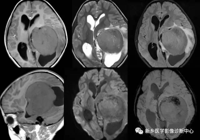 在侧脑室三角区看到占位，要想到这8种肿瘤