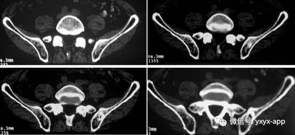 【病例】左侧髂骨翼骨化性纤维瘤1例CT 【病例】左侧髂骨翼骨化性纤维瘤1例CT