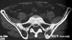 【病例】左侧髂骨翼骨化性纤维瘤1例CT 【病例】左侧髂骨翼骨化性纤维瘤1例CT