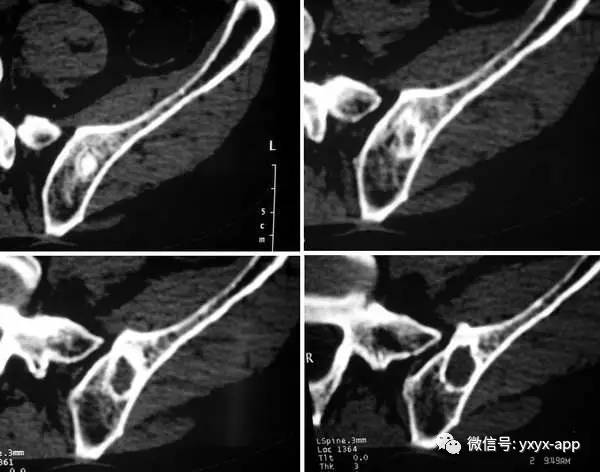 【病例】左侧髂骨翼骨化性纤维瘤1例CT 【病例】左侧髂骨翼骨化性纤维瘤1例CT