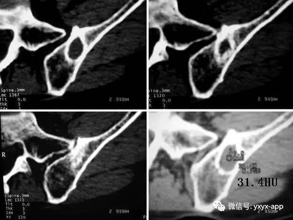 【病例】左侧髂骨翼骨化性纤维瘤1例CT