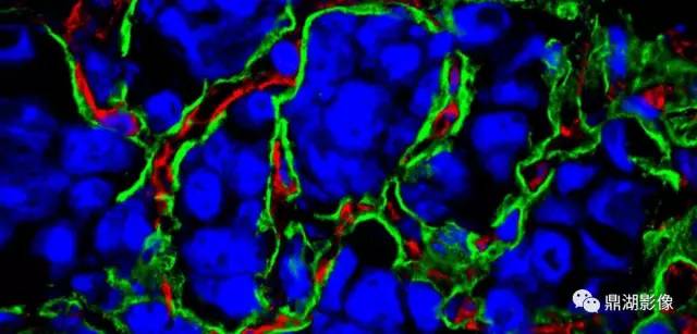 肺结节里可见肿瘤血管？请不要被“专家”忽悠