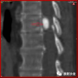 神经中轴钙化性假瘤的影像诊断及鉴别诊断