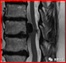 神经中轴钙化性假瘤的影像诊断及鉴别诊断