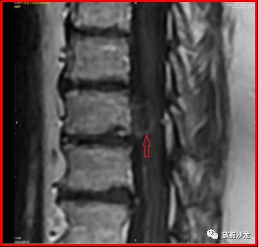 神经中轴钙化性假瘤的影像诊断及鉴别诊断