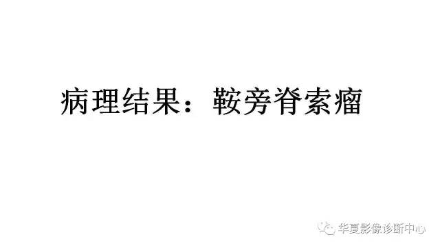 【病例】鞍旁脊索瘤1例CT及MR