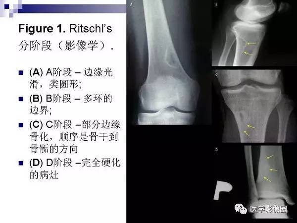 【PPT】非骨化性纤维瘤影像诊断
