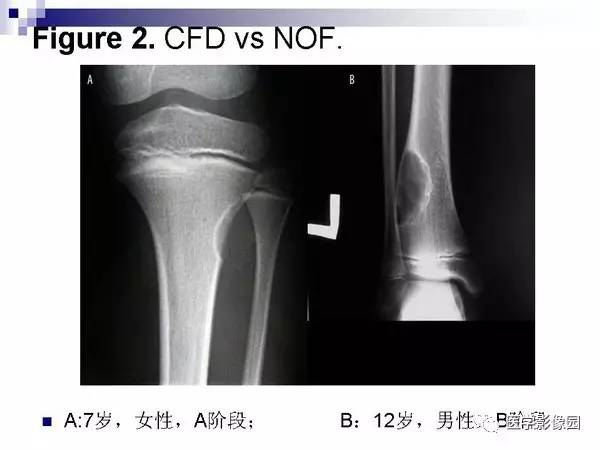 【PPT】非骨化性纤维瘤影像诊断