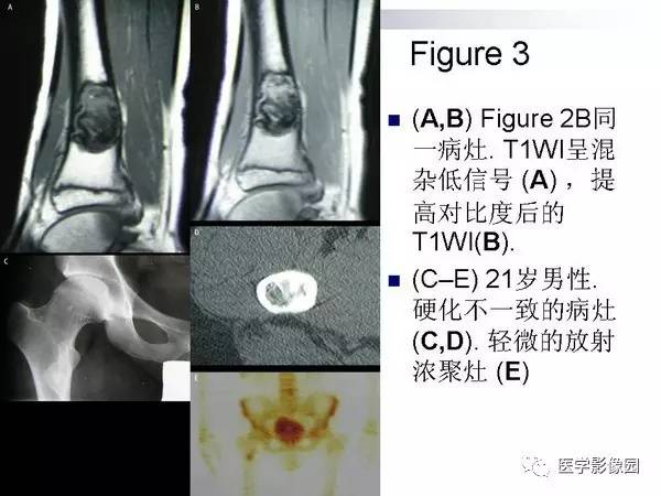 【PPT】非骨化性纤维瘤影像诊断