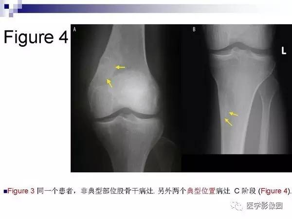 【PPT】非骨化性纤维瘤影像诊断