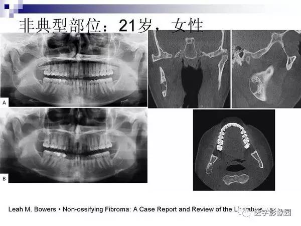 【PPT】非骨化性纤维瘤影像诊断