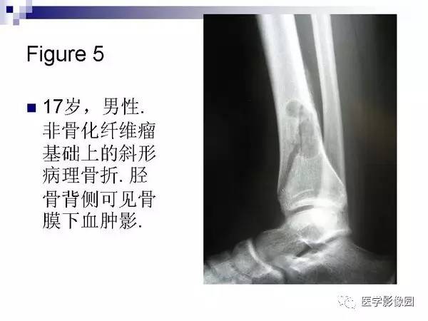 【PPT】非骨化性纤维瘤影像诊断