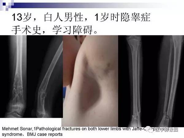 【PPT】非骨化性纤维瘤影像诊断