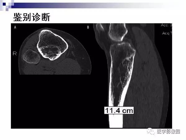 【PPT】非骨化性纤维瘤影像诊断