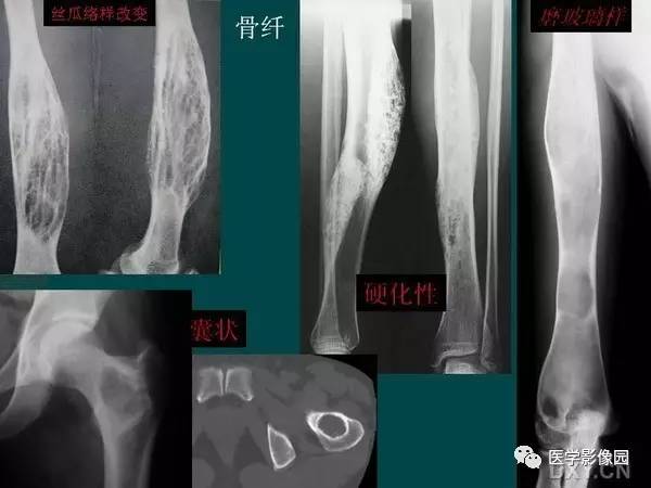 【PPT】非骨化性纤维瘤影像诊断
