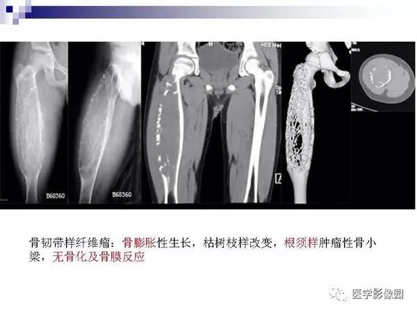 【PPT】非骨化性纤维瘤影像诊断