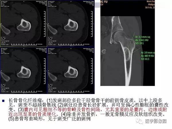 【PPT】非骨化性纤维瘤影像诊断