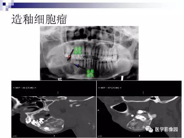 【PPT】非骨化性纤维瘤影像诊断
