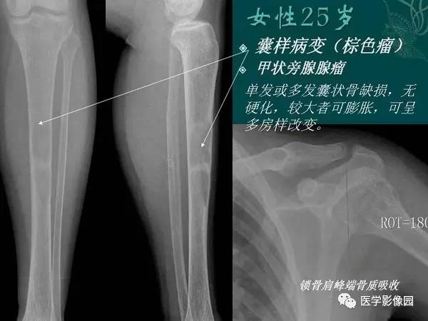 【PPT】非骨化性纤维瘤影像诊断