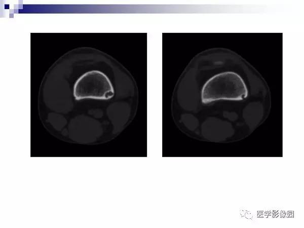 【PPT】非骨化性纤维瘤影像诊断