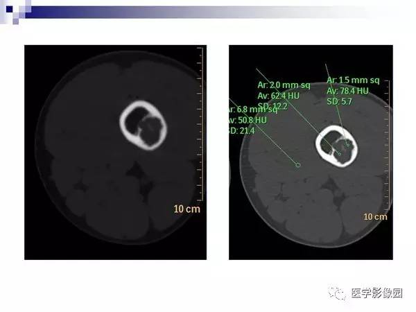 【PPT】非骨化性纤维瘤影像诊断
