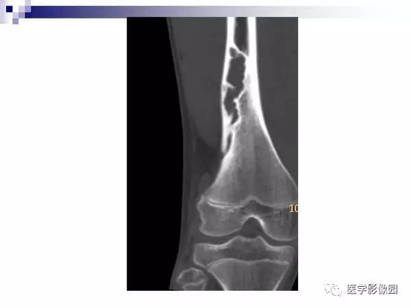 【PPT】非骨化性纤维瘤影像诊断
