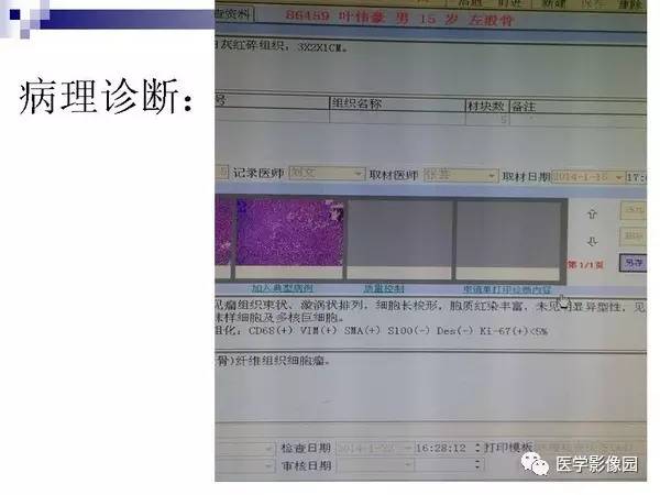 【PPT】非骨化性纤维瘤影像诊断