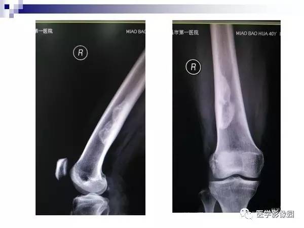 【PPT】非骨化性纤维瘤影像诊断