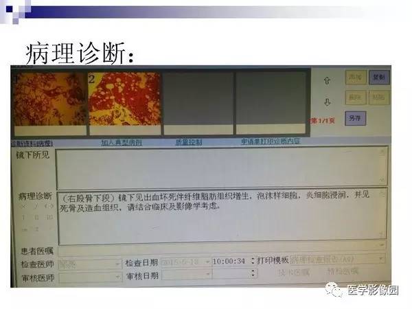 【PPT】非骨化性纤维瘤影像诊断