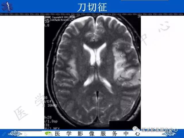 【影像征象】刀切征