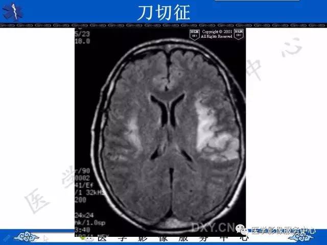 【影像征象】刀切征