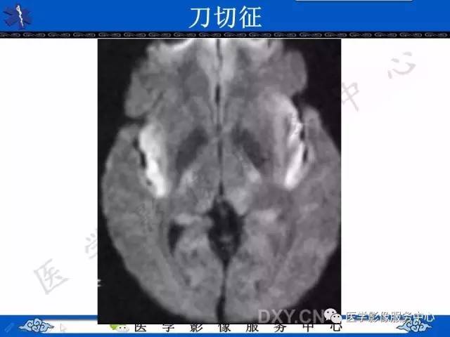 【影像征象】刀切征