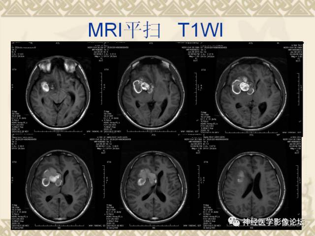 【病例】动静脉畸形一例MR