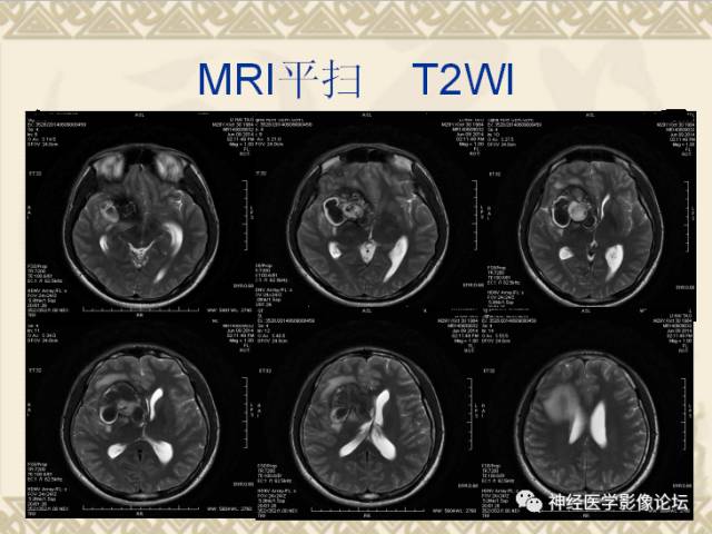 【病例】动静脉畸形一例MR
