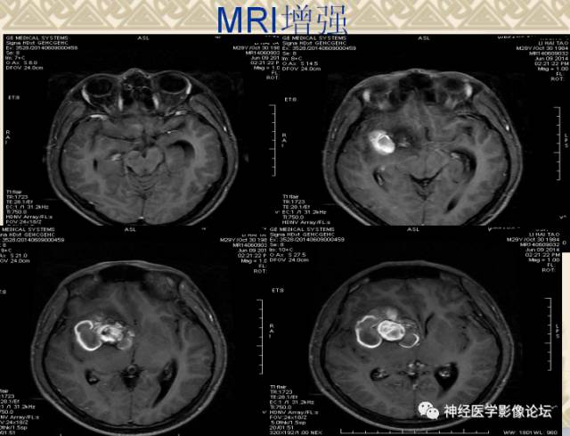 【病例】动静脉畸形一例MR