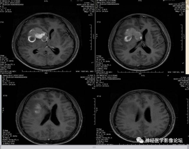 【病例】动静脉畸形一例MR