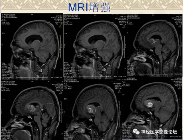【病例】动静脉畸形一例MR