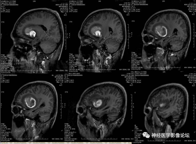 【病例】动静脉畸形一例MR