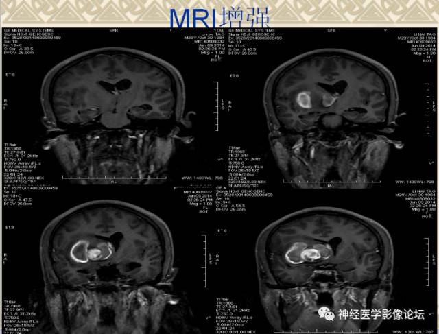 【病例】动静脉畸形一例MR