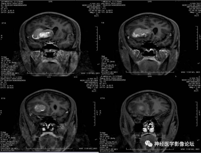 【病例】动静脉畸形一例MR